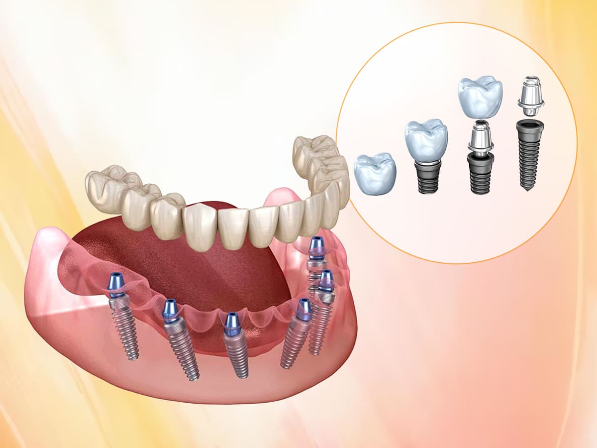 Best Implant Dentist in Akshayanagar
