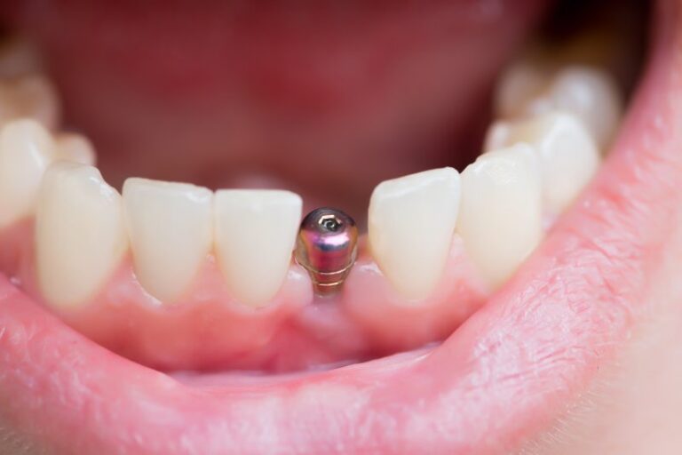 Is Dental Implant Surgery Painful? Everything You Need to Know Before Treatment​