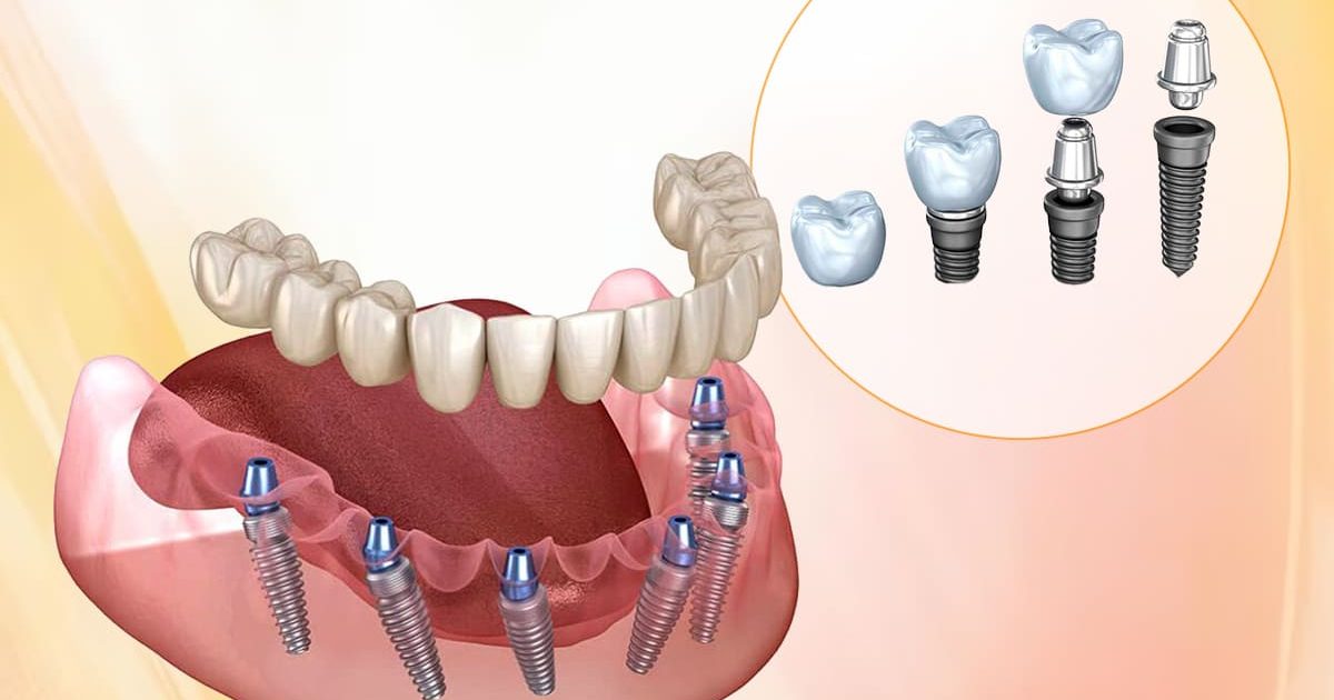Best Implant Dentist in Akshayanagar